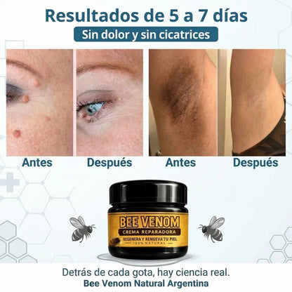 Bee venom - Elimina Verrugas y Papilomas Desde Casa, Sin Dolor y sin que vuelvan